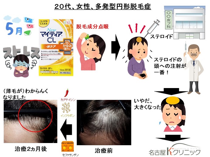 円形脱毛症　病院